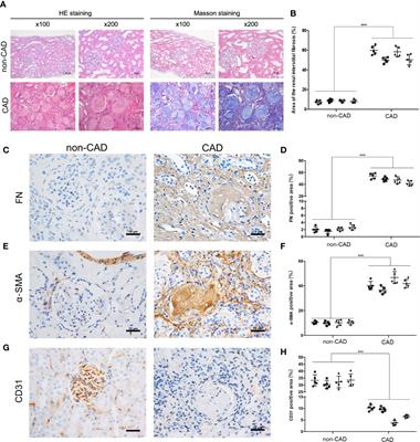 Impaired ATG16L-Dependent Autophagy Promotes Renal Interstitial Fibrosis in Chronic Renal Graft Dysfunction Through Inducing EndMT by NF-κB Signal Pathway